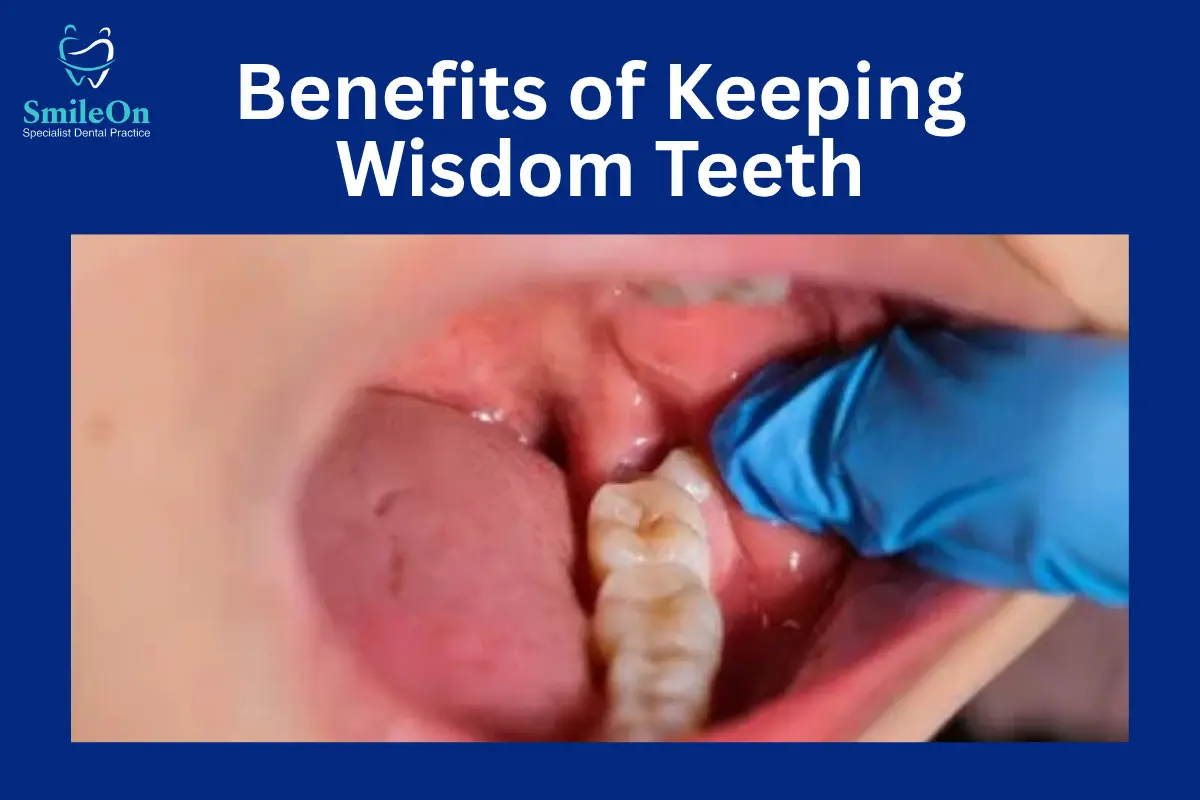 Benefits of Keeping Wisdom Teeth
