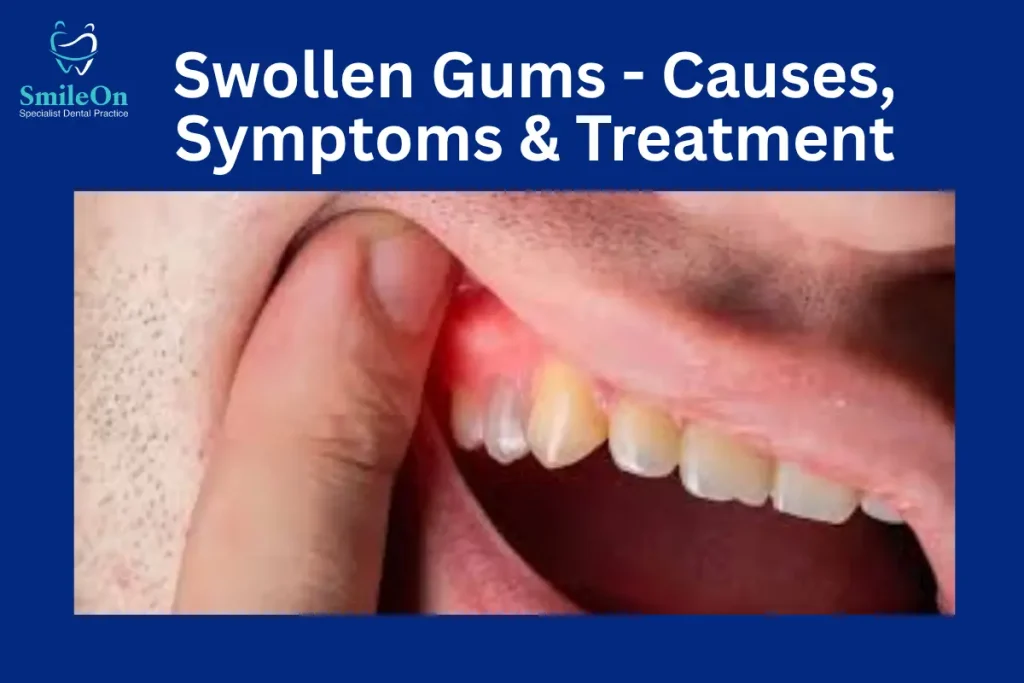 Swollen Gums Causes