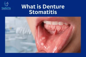 Denture Stomatitis