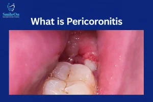 Pericoronitis