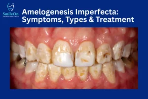 Amelogenesis Imperfecta