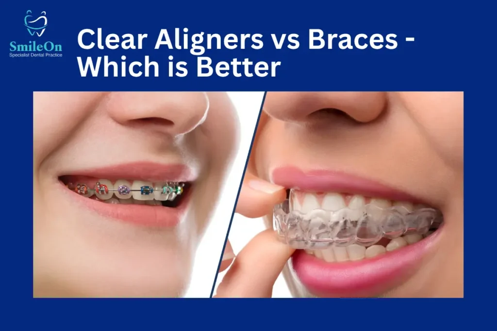 Aligners vs Braces