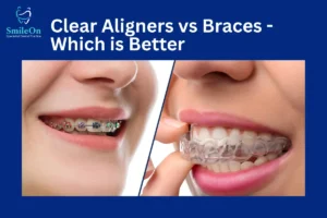 Aligners vs Braces