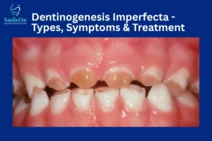Dentinogenesis Imperfecta