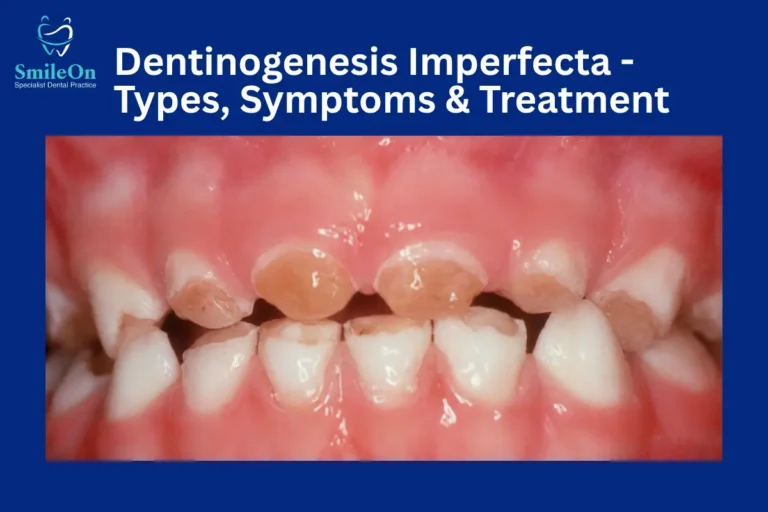 Dentinogenesis Imperfecta