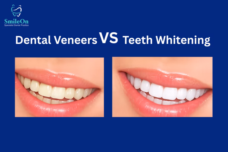 Dental Veneers vs Teeth Whitening