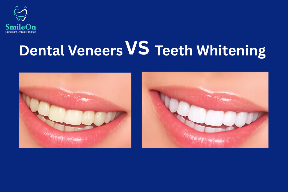 Dental Veneers vs Teeth Whitening