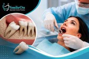 wisdom tooth extraction in Lahore