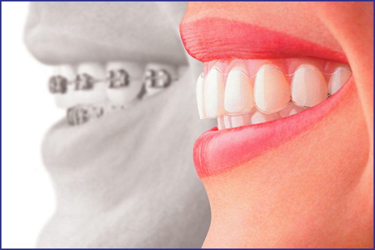 Benefits of Invisalign clear aligners over traditional braces